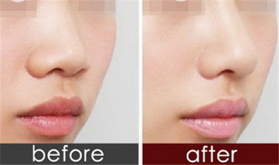 隆鼻手术过程图解：塑造完美的鼻部美学