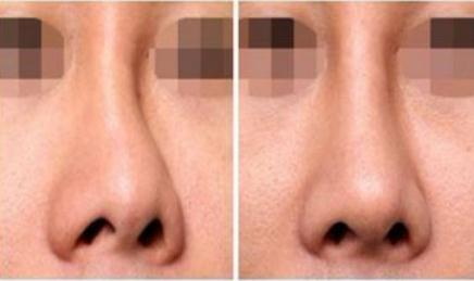 你知道胶原蛋白隆鼻的优势有哪些吗？