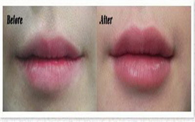 丰唇手术好不好，常见的丰唇的方法有哪几种？
