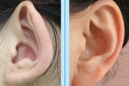 耳洞增生怎么消除(什么是耳洞增生？)