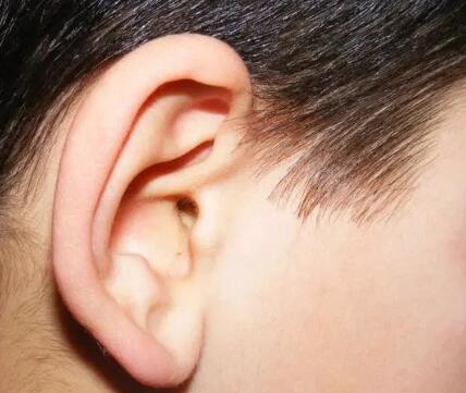 小耳畸形是什么原因