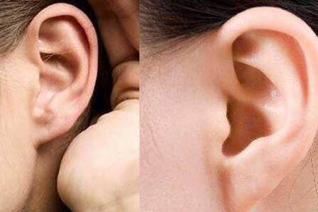 耳部整形：杯状耳修脸的方法