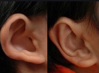 最关键的全耳再造术处理措施