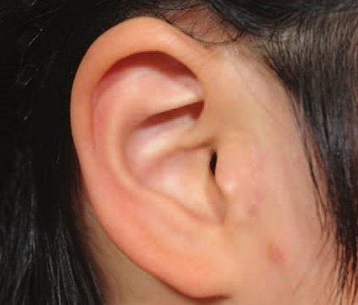 儿童耳朵先天性畸形到哪里做手术效果好_耳朵穿刺手术是大手术吗