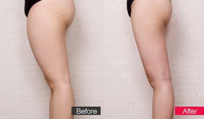 丰臀瘦臀整形术如何让你身材更好？