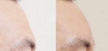 眼角和脸颊两侧长斑怎么去除(眼角和脸颊两侧长斑的原因)