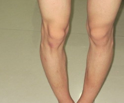 罗圈腿是怎么形成的(罗圈腿一般怎么形成的)