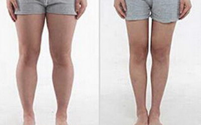 成年改善o型腿最有效的方法