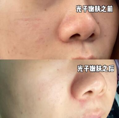 面部去疤痕手术方案(面部手术后凹陷疤痕几个月能长平)
