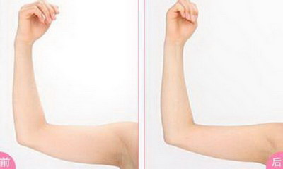 激光瘦手臂能维持多久