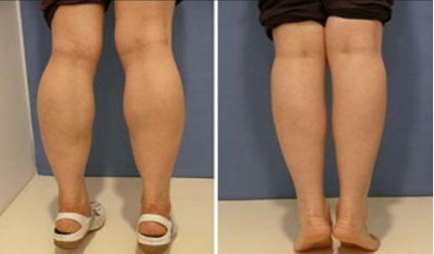 吸脂大腿要多久恢复正常走路「吸脂大腿要多久恢复正常」