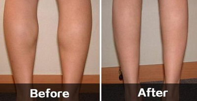 腿部抽脂后多久可以运动「腿部抽脂肪多久可以恢复」