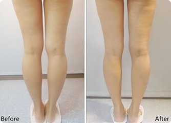 大腿内侧黑色素可以去美容院去除吗