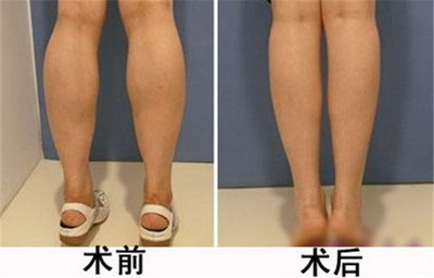 肌肉腿可以通过拉伸消除吗(肌肉腿通过按摩可以瘦吗)