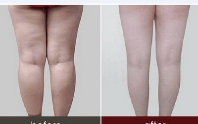 初中女生如何瘦小腿护理呀？