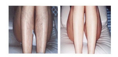 女生腿毛突然变多变长是什么原因
