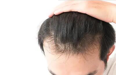 严重脱发怎么办_干细胞治疗脱发上市了吗