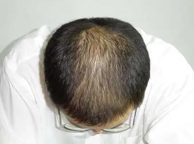 脂溢性脱发用生姜擦头皮能生发吗