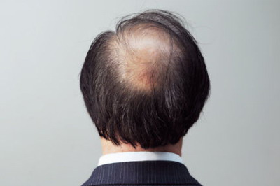 遗传性脱发种植头发靠谱吗