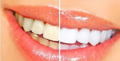 牙齿脱敏治疗能维持多久(一次牙齿脱敏治疗能维持多久)
