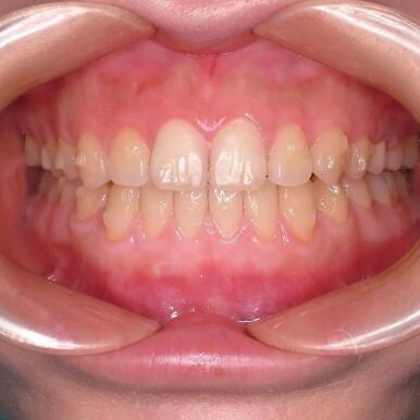 牙齿矫正期间需要注意的事项(牙齿矫正期间需要戴牙套吗)