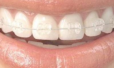 牙齿内倾矫正前后图片_矫正后会有牙齿内倾