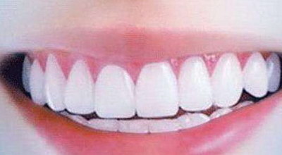 牙齿畸形可以矫正吗「牙齿畸形严重可以矫正吗」