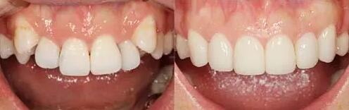 牙齿矫正后下牙外倾(牙齿矫正后下牙外倾正常吗)