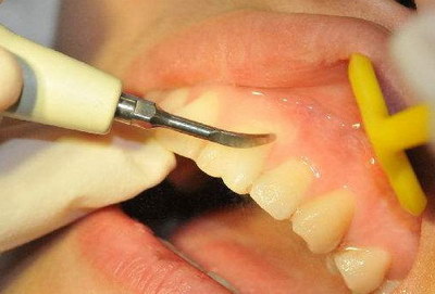 牙根管治疗过程(门牙根管治疗过程)