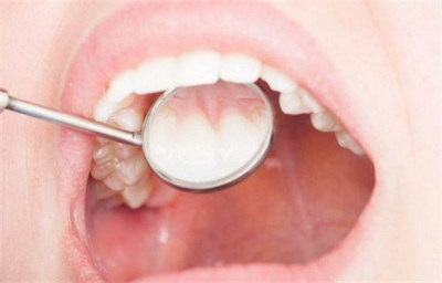 牙齿保持器的清洁方法【如何保持牙齿的清洁】
