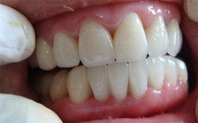左边牙齿酸痛(左边牙齿酸痛快速缓解)