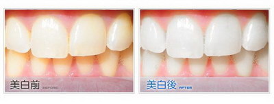 牙齿需要矫正的6种类型[牙齿需要矫正的种类]