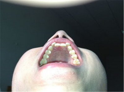 牙龈炎和牙周炎区别的重要指征是[牙髓炎牙周炎牙龈炎区别]
