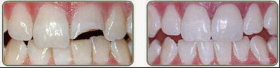 牙齿楔状缺损补牙后能用多久