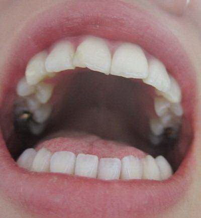 牙齿质量差吃什么药(牙齿质量差是什么原因)