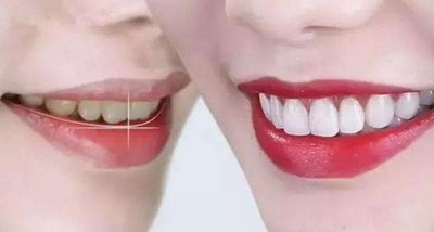 根管治疗后可以补牙再做冠修复么(根管治疗用树脂补牙后两年可以在做牙套吗)