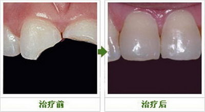 牙齿做嵌体修复期间注意什么
