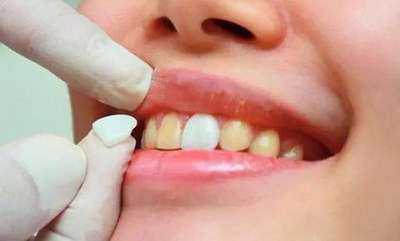 牙齿磨损修复怎么做咬合抬高[牙齿磨损严重怎么修复]