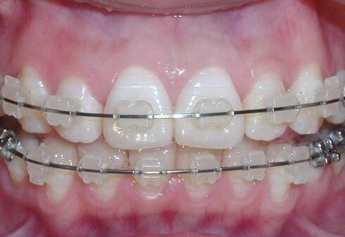 牙冠修复和做牙套有什么区别