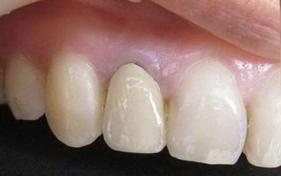 牙周炎拔牙后装假牙能用多久