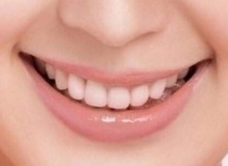 牙齿贴面是什么