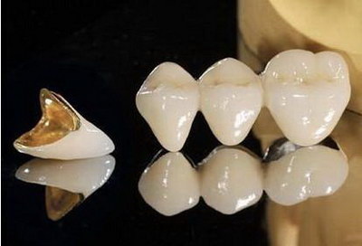 种植牙二期手术后多久可以装牙(种植牙二期手术后多久装牙冠)