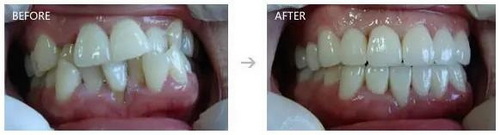 碘伏可以放牙齿消炎吗(什么是碘伏？)