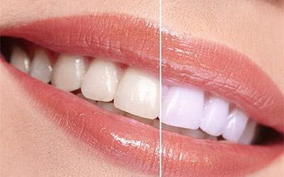 塑料牙齿矫正器副作用