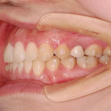 牙齿贴面是什么概念