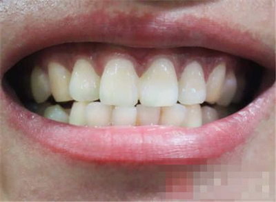 长期牙龈出血怎么治