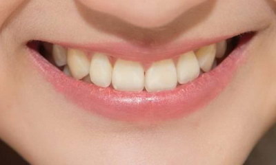 儿童牙齿可以矫正吗