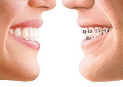 矫正牙齿拔牙的缝隙多长时间能消失「矫正牙齿拔牙需要多长时间修复」
