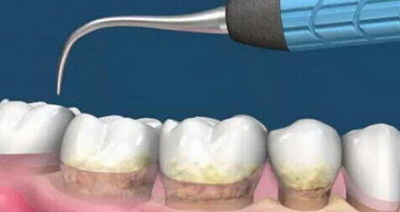牙槽骨手术怎么做(牙槽骨手术怎么操作)