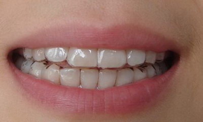 缺失牙齿修复方法